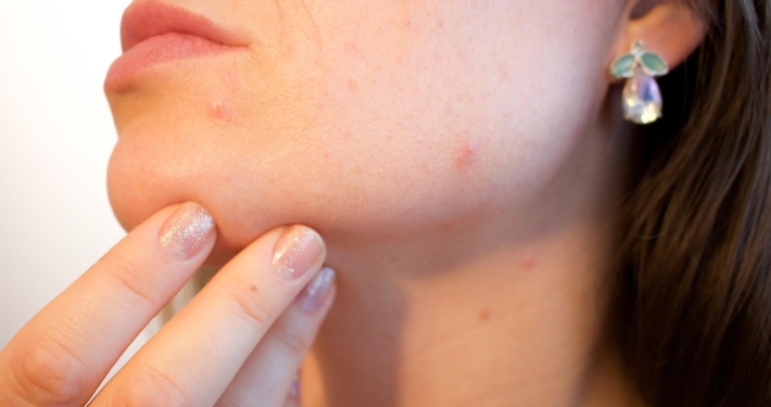 Hoe je acne en littekens effectief aanpakt