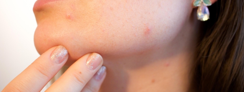 Hoe je acne en littekens effectief aanpakt